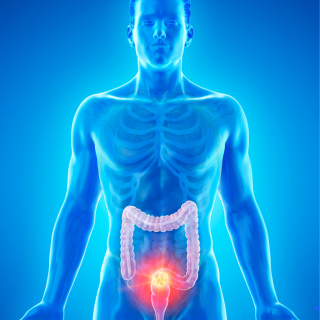 2025 EDW Multidisciplinary Rectal Tumor Board (RSS) Banner